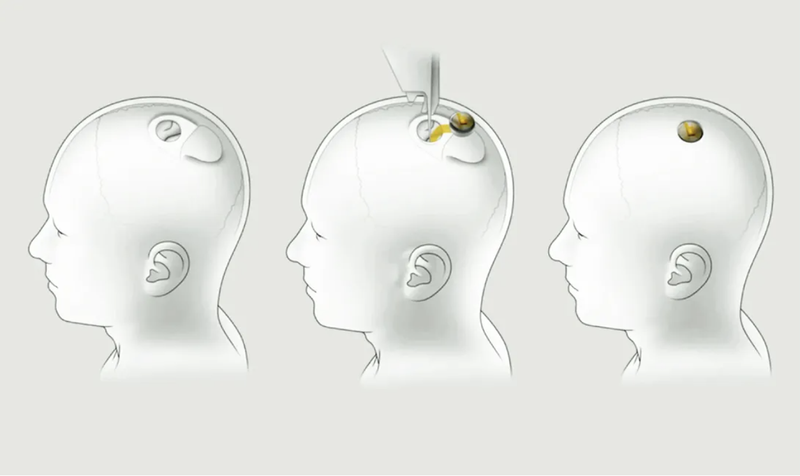 马斯克发明植入脑机接口_马斯克人脑接口技术_马斯克提及Neuralink未来计划：2025年将为部分患者提供脑机接口植入
